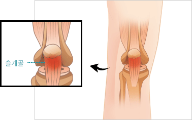 슬개골 건염 이미지